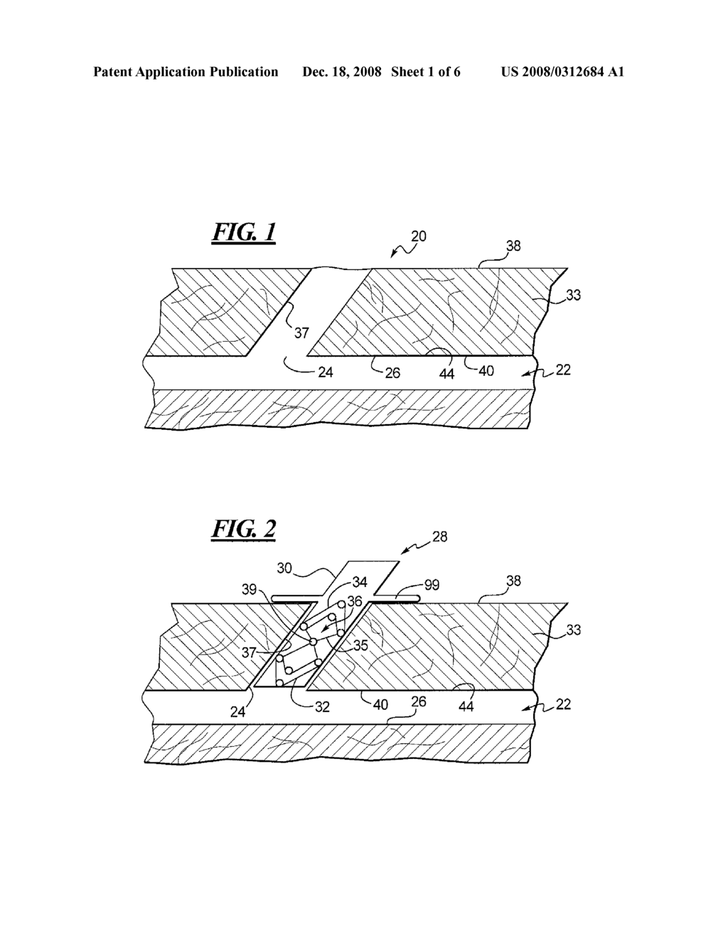 Apparatus and Method for Closing an Opening in a Blood Vessel Using a Permanent Implant - diagram, schematic, and image 02