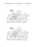 Apparatus and Method for Closing an Opening in a Blood Vessel Using a Permanent Implant diagram and image