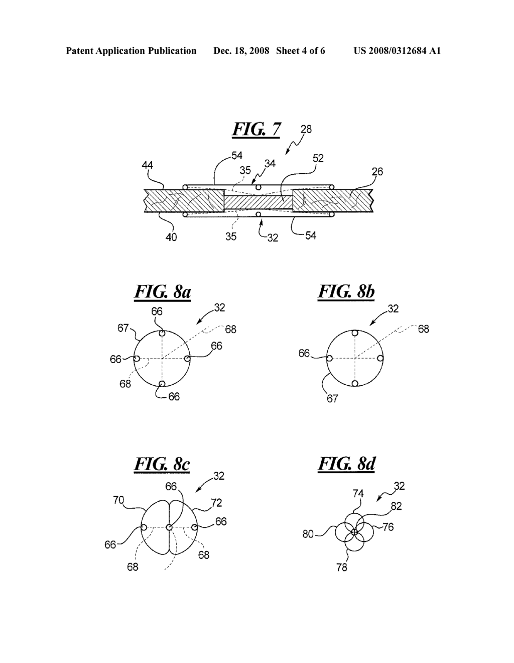 Apparatus and Method for Closing an Opening in a Blood Vessel Using a Permanent Implant - diagram, schematic, and image 05