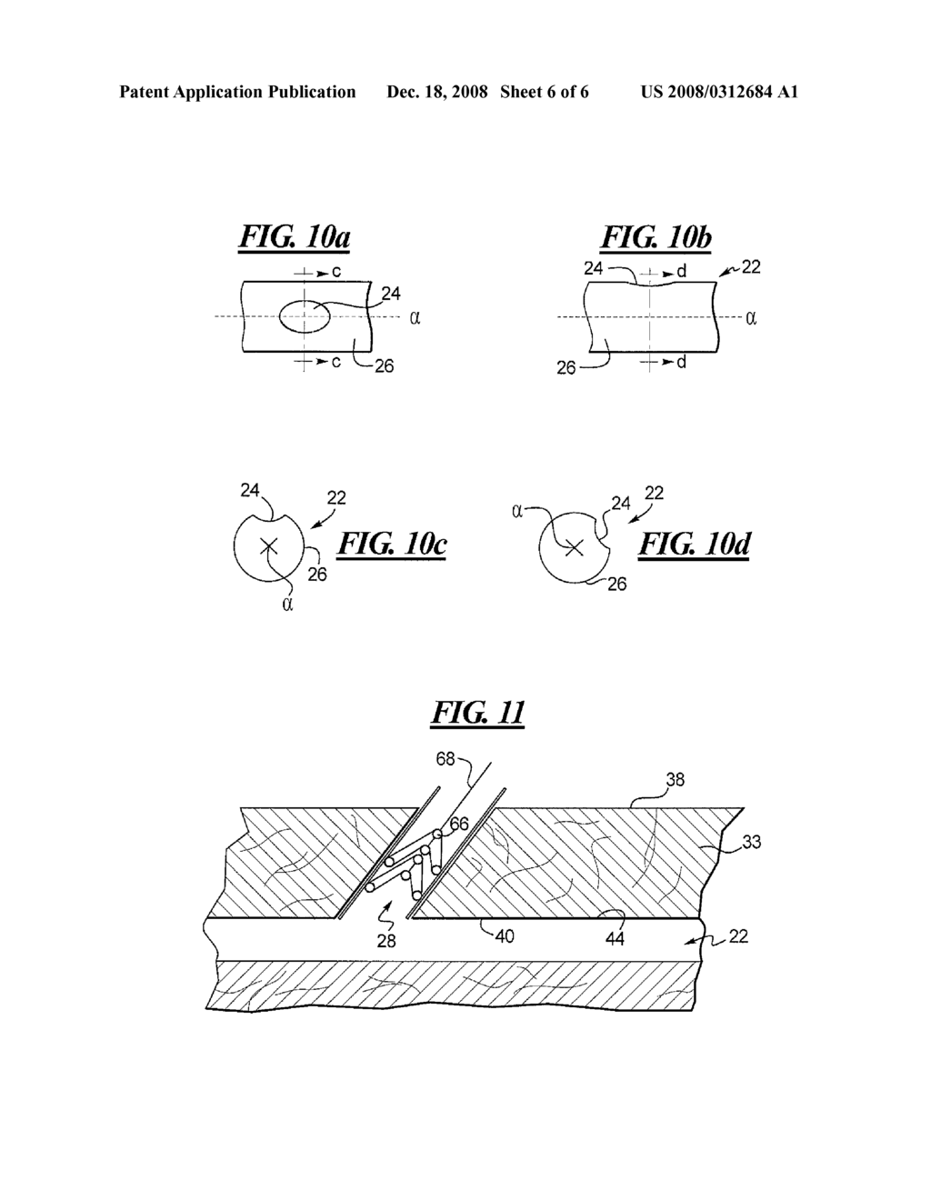 Apparatus and Method for Closing an Opening in a Blood Vessel Using a Permanent Implant - diagram, schematic, and image 07