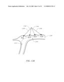 METHODS AND DEVICES FOR RECONFIGURING A BODY ORGAN diagram and image