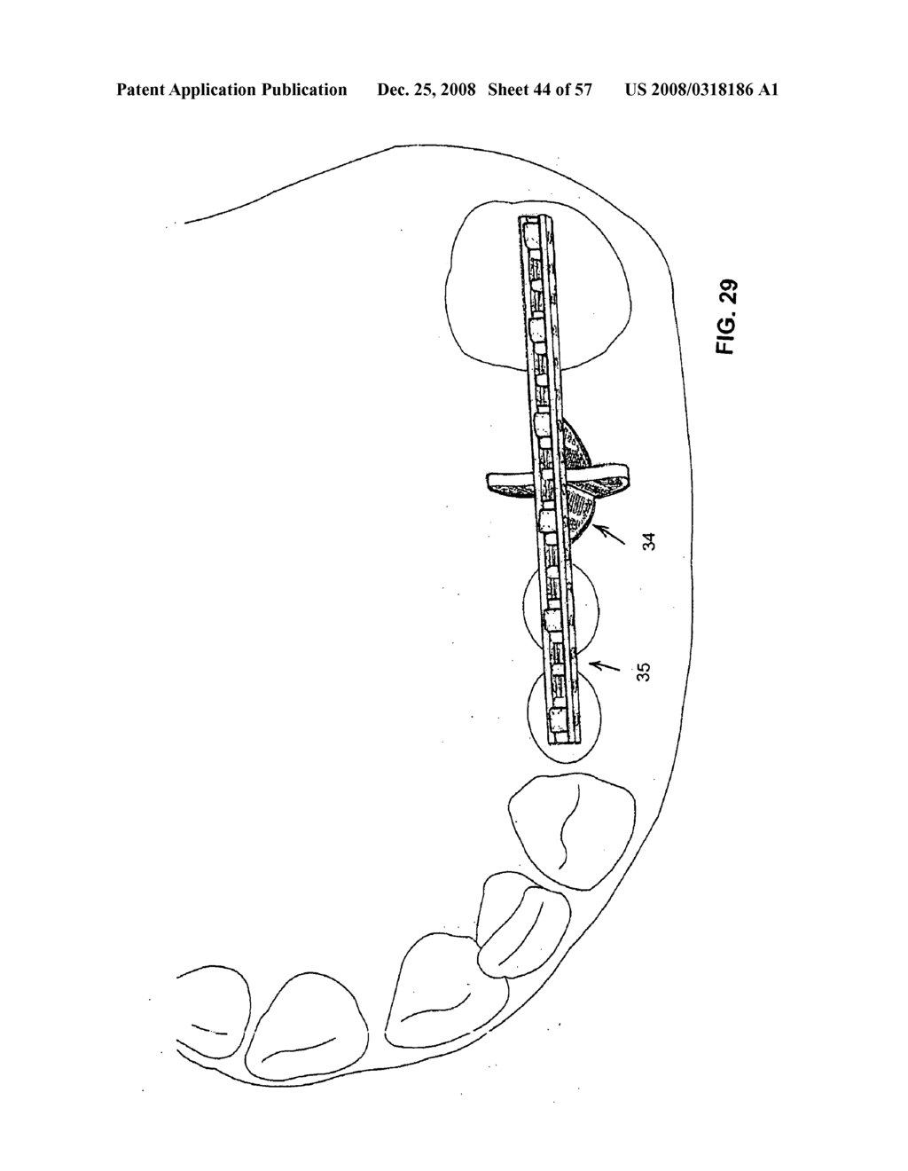 DENTAL DEVICE, SUCH AS A BRIDGE OR INSERT - diagram, schematic, and image 45
