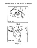 Medical-use two part reactive adhesive and medical-use resin having self-degradation property diagram and image