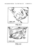 Medical-use two part reactive adhesive and medical-use resin having self-degradation property diagram and image