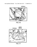 Medical-use two part reactive adhesive and medical-use resin having self-degradation property diagram and image