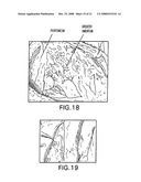 Medical-use two part reactive adhesive and medical-use resin having self-degradation property diagram and image