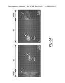 PULSED CAVITATIONAL ULTRASOUND THERAPY diagram and image