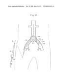 Medical catheter and a catheter assemble diagram and image