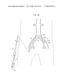 Medical catheter and a catheter assemble diagram and image