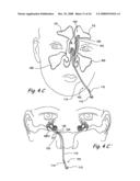 Devices and Methods for Delivering Therapeutic Substances for the Treatment of Sinusitis and Other Disorders diagram and image