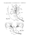 Devices and Methods for Delivering Therapeutic Substances for the Treatment of Sinusitis and Other Disorders diagram and image