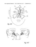 Devices and Methods for Delivering Therapeutic Substances for the Treatment of Sinusitis and Other Disorders diagram and image