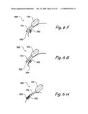 Devices and Methods for Delivering Therapeutic Substances for the Treatment of Sinusitis and Other Disorders diagram and image