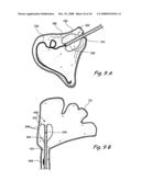 Devices and Methods for Delivering Therapeutic Substances for the Treatment of Sinusitis and Other Disorders diagram and image