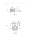 Methods and devices for treating bone after high velocity and/or trauma fracture diagram and image