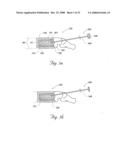 Methods and devices for treating bone after high velocity and/or trauma fracture diagram and image