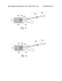 Methods and devices for treating bone after high velocity and/or trauma fracture diagram and image