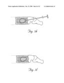 Methods and devices for treating bone after high velocity and/or trauma fracture diagram and image