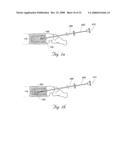 Methods and devices for treating bone after high velocity and/or trauma fracture diagram and image