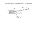 Methods and devices for treating bone after high velocity and/or trauma fracture diagram and image