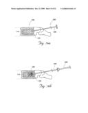 Methods and devices for treating bone after high velocity and/or trauma fracture diagram and image