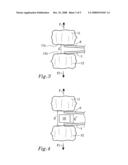 Device for the Application of Resilient Material Between Vertebras diagram and image