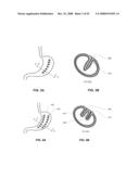 METHODS AND DEVICES FOR REDUCING GASTRIC VOLUME diagram and image