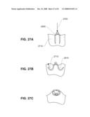 METHODS AND DEVICES FOR REDUCING GASTRIC VOLUME diagram and image