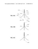 METHODS AND DEVICES FOR REDUCING GASTRIC VOLUME diagram and image