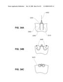 METHODS AND DEVICES FOR REDUCING GASTRIC VOLUME diagram and image