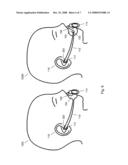 PACIFIER ACCOMMODATION DEVICE diagram and image