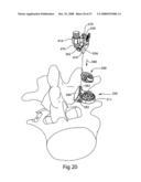 SYSTEM AND METHOD FOR FACET JOINT REPLACEMENT diagram and image