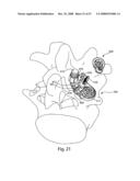 SYSTEM AND METHOD FOR FACET JOINT REPLACEMENT diagram and image