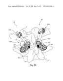 SYSTEM AND METHOD FOR FACET JOINT REPLACEMENT diagram and image