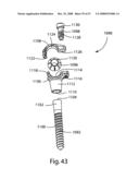 SYSTEM AND METHOD FOR FACET JOINT REPLACEMENT diagram and image