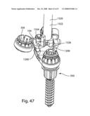 SYSTEM AND METHOD FOR FACET JOINT REPLACEMENT diagram and image