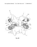 SYSTEM AND METHOD FOR FACET JOINT REPLACEMENT diagram and image