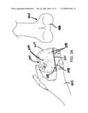 PATIENT-MATCHED SURGICAL COMPONENT AND METHODS OF USE diagram and image