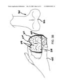 PATIENT-MATCHED SURGICAL COMPONENT AND METHODS OF USE diagram and image