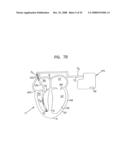 Endocardial Pacing Devices and Methods Useful for Resynchronization and Defibrillation diagram and image