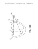 Endocardial Pacing Devices and Methods Useful for Resynchronization and Defibrillation diagram and image