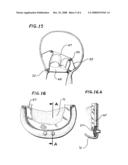 BIOPROSTHETIC HEART VALVE diagram and image