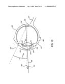 ORTHOVOLTAGE RADIOSURGERY diagram and image