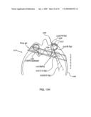 ORTHOVOLTAGE RADIOSURGERY diagram and image