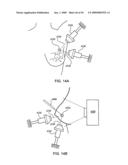 ORTHOVOLTAGE RADIOSURGERY diagram and image