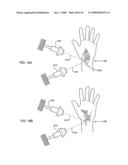 ORTHOVOLTAGE RADIOSURGERY diagram and image