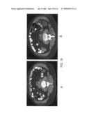 Methods of treating cancer with HDAC inhibitors diagram and image