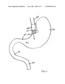 GASTROINTESTINAL BYPASS SLEEVE AS AN ADJUNCT TO BARIATRIC SURGERY diagram and image