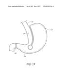 GASTROINTESTINAL BYPASS SLEEVE AS AN ADJUNCT TO BARIATRIC SURGERY diagram and image