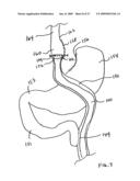 GASTROINTESTINAL BYPASS SLEEVE AS AN ADJUNCT TO BARIATRIC SURGERY diagram and image